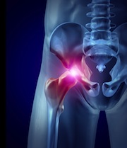 stryker hip replacement recall