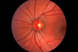 optic nerve avulsion