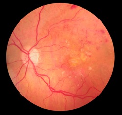 retinal detachment